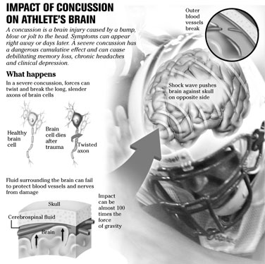 Concussions can leave permanent damage on the brain.